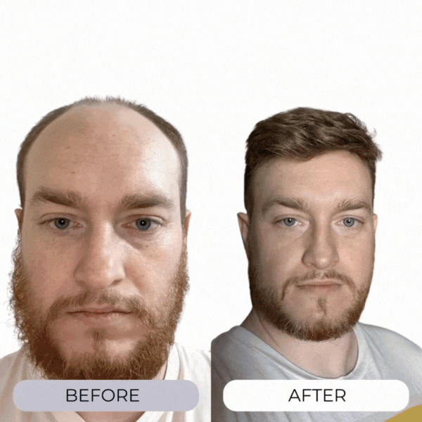 MICRO-INFUSE® Hair Technology – For Men