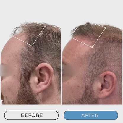 MICRO-INFUSE® Hair Technology – For Men